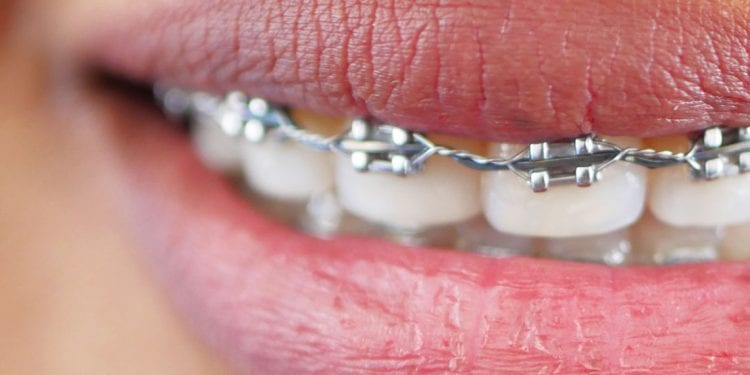 BIEN ÊTRE : Sourire de tout son appareil dentaire