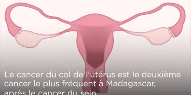 SANTE – Quand, comment et pourquoi se faire dépister du cancer du col de l’utérus ?
