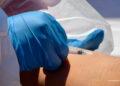 ÉPIDÉMIE – Un jeune homme de 20 ans décède de la Mpox à l’hôpital d’Andohatapenaka